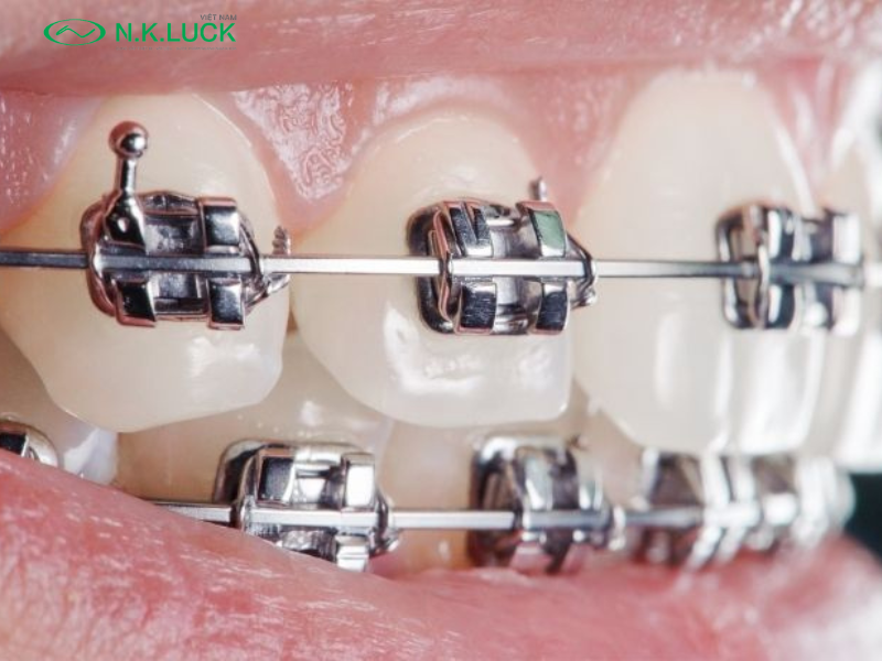 Hệ thống mắc cài đặc biệt