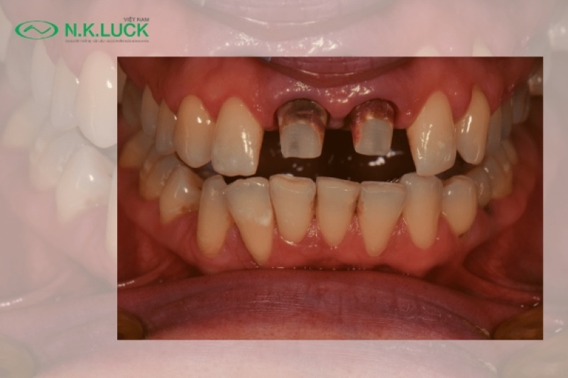 Nhược điểm của việc bọc răng sứ