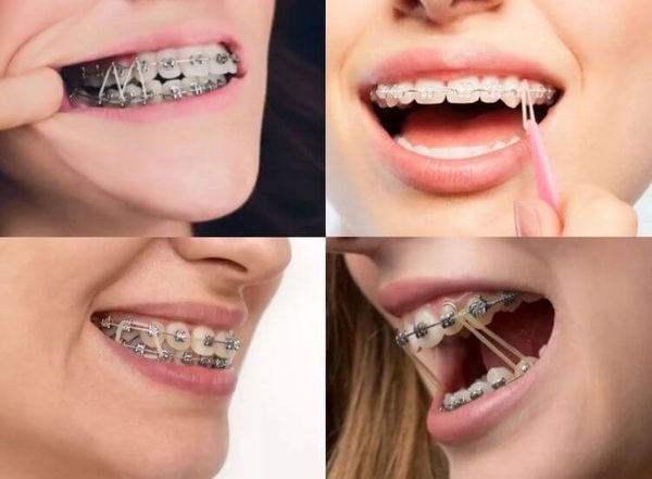 Có 3 loại dây thun liên hàm được sử dụng phổ biến