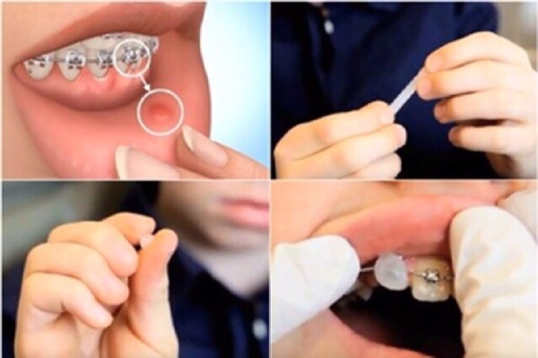 Những lưu ý quan trọng bạn cần biết khi sử dụng sáp nha khoa