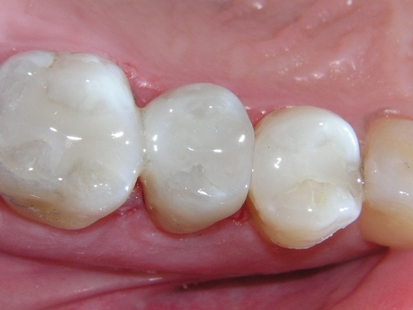 Trám răng tạm thời bằng Composite