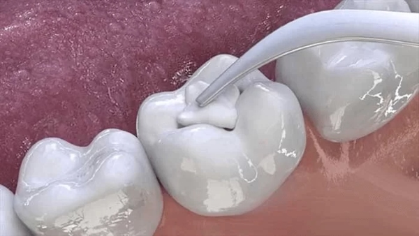 Trám răng tạm thời bằng Glass Ionomer Cement