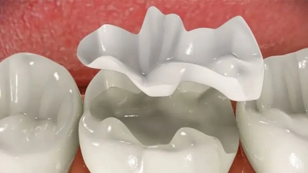 Trám răng tạm thời bằng sứ