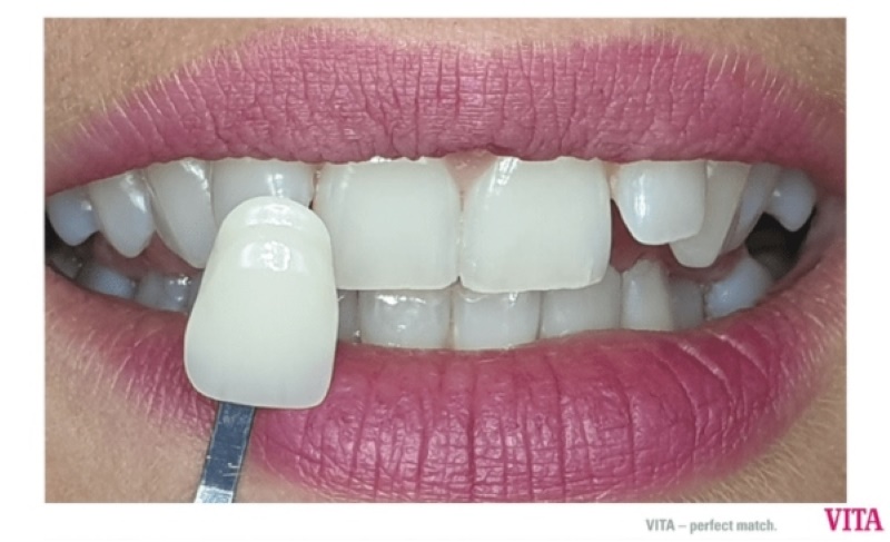 Ưu điểm và nhược điểm của bọc răng sứ không mài