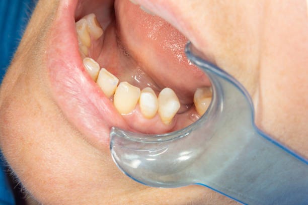 Các thiết bị cần thiết để đo độ vững ổn Implant trong Nha Khoa Các thiết bị cần thiết để đo độ vững ổn Implant trong Nha Khoa