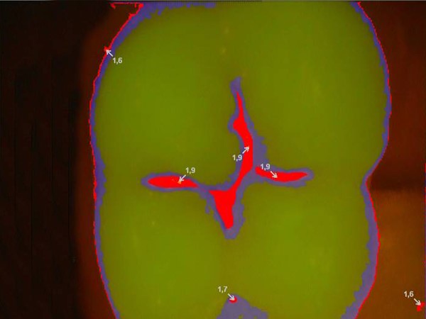 Chẩn đoán kỹ thuật số để phát hiện các tổn thương ở đường gân Chẩn đoán kỹ thuật số để phát hiện các tổn thương ở đường gân