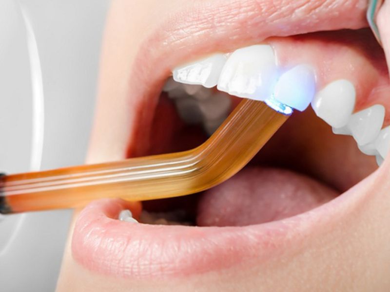 Gợi ý cách chăm sóc răng sau khi thực hiện trám răng Composite Gợi ý cách chăm sóc răng sau khi thực hiện trám răng Composite