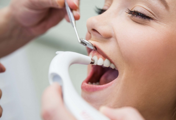 cạo vôi và đánh bóng răng