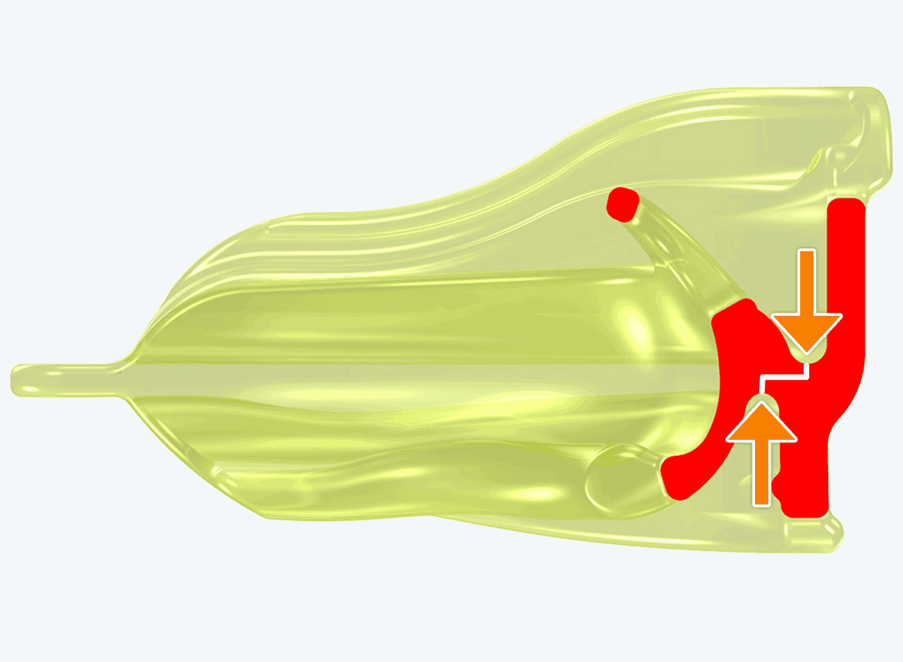 myobrace for interceptive P3R sau