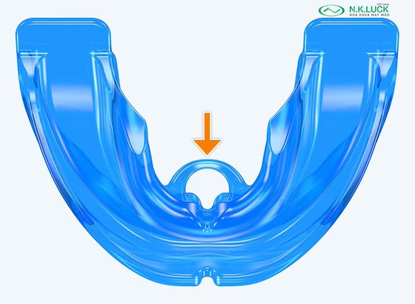 myobrace for teen T4 sau