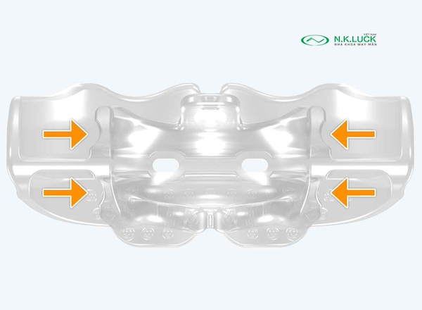 myobrace for teen T1 BWS sau