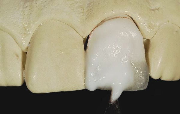 Đắp sứ dạng bột và nước lên răng