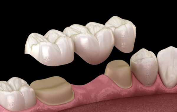 Phương pháp phục hình cầu răng