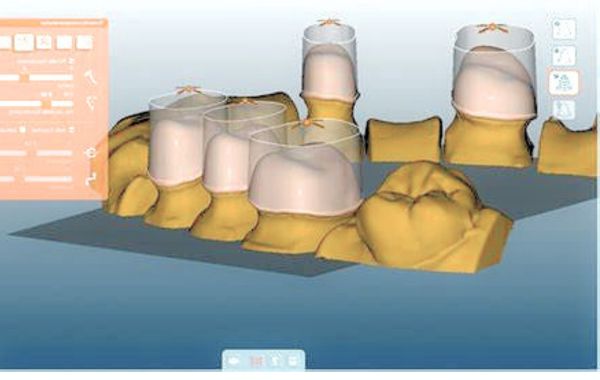 Phục hình răng CAD/CAM giúp tạo hình dạng răng chính xác, đảm bảo độ thẩm mỹ