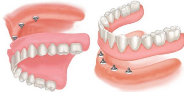Răng giả tháo lắp trên Implant Răng giả tháo lắp trên Implant