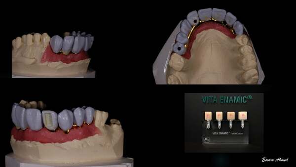 Xác định mục tiêu và tính chất cụ thể của công việc nha khoa của bạn. Một số vật liệu labo có tính chất và ứng dụng riêng biệt